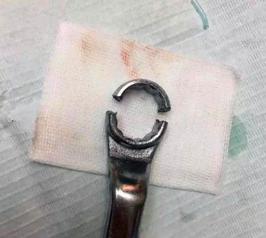 男子下体被扳手套住17小时 最后口腔科医生解了围